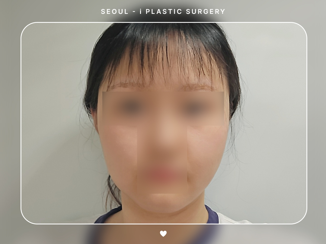 #얼굴지방흡입 #이중턱
