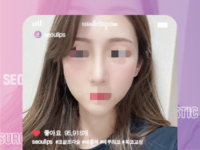 리얼셀카_#코끝조각술 #비중격 #메부리코 #복코교정