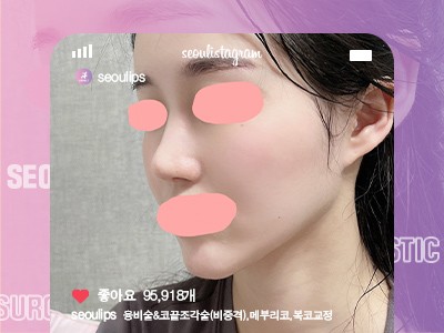 리얼셀카_#융비술&코끝조각술(비중격) #메부리코 #복코교정