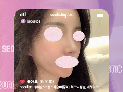 리얼셀카_#융비술&코끝조각술(비중격) #복코교정술 #메부리코