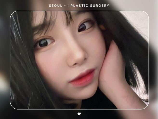 #자연유착 #앞트임 #뒤밑트임
