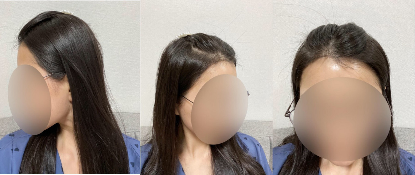 헤어라인 수술 후기입니당