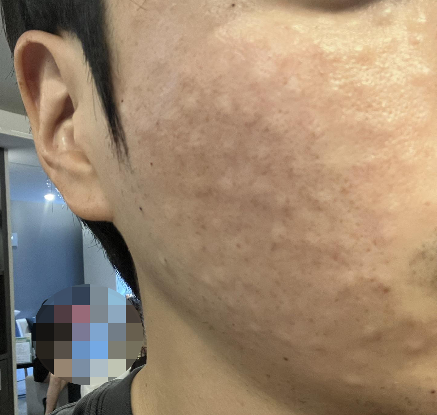 촘촘한 엠보에 친절한 응대까지, 리쥬란 만족스러웠습니다.