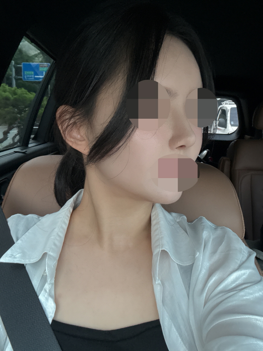 재수술이라 걱정 많이 했는데 너무너무 만족스러운 결과예용!!