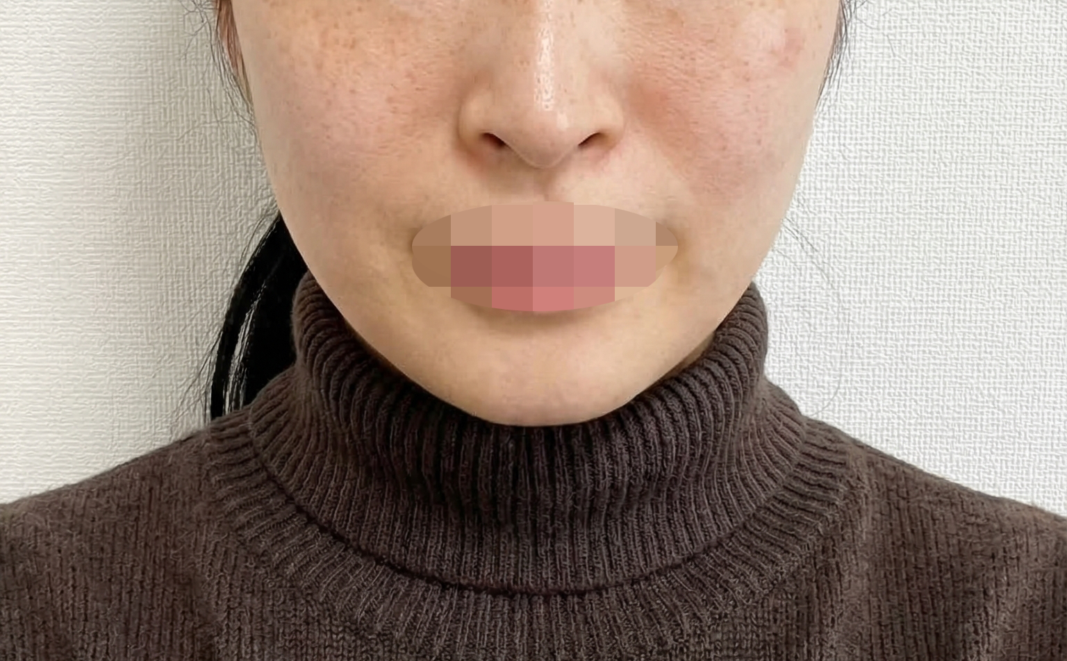 리쥬란이랑 온다리프팅 같이 받았는데 다음 달에도 오려고요 ㅎㅎ