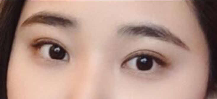 쌍수+앞트임 후기~^^