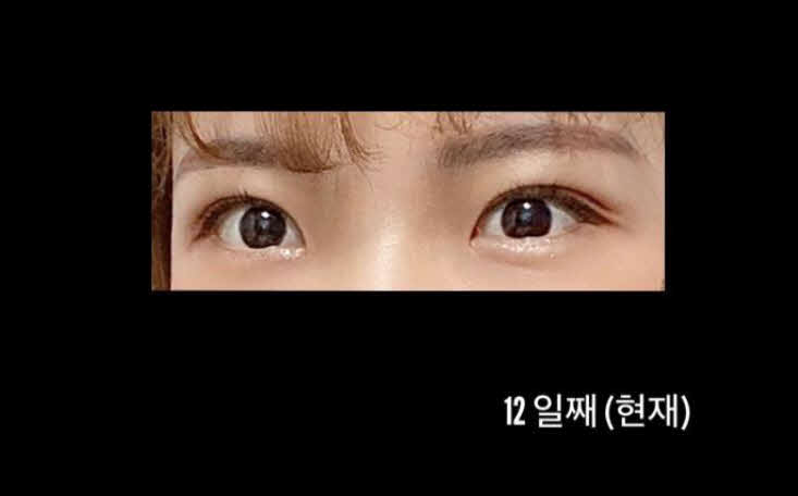 서울아이에서 쌍수했어용ㅎ