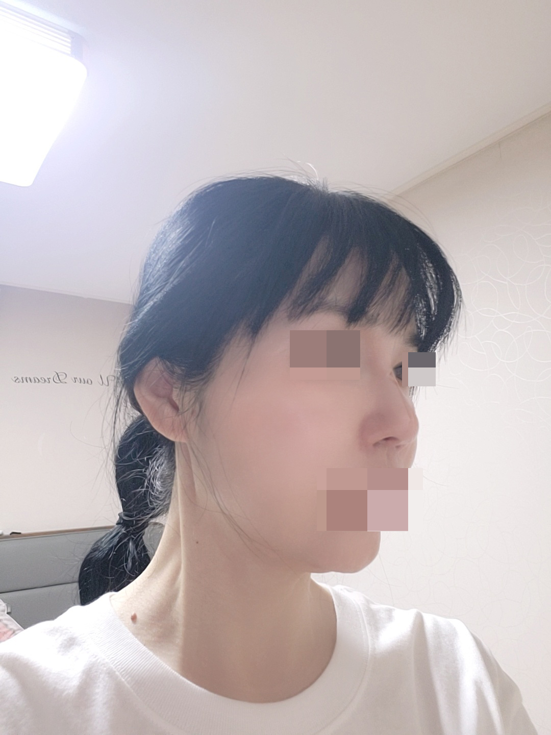 전후가 확실하게 차이 날정도로 코끝 콧대가 너무 예쁘게 자리 잡았어요