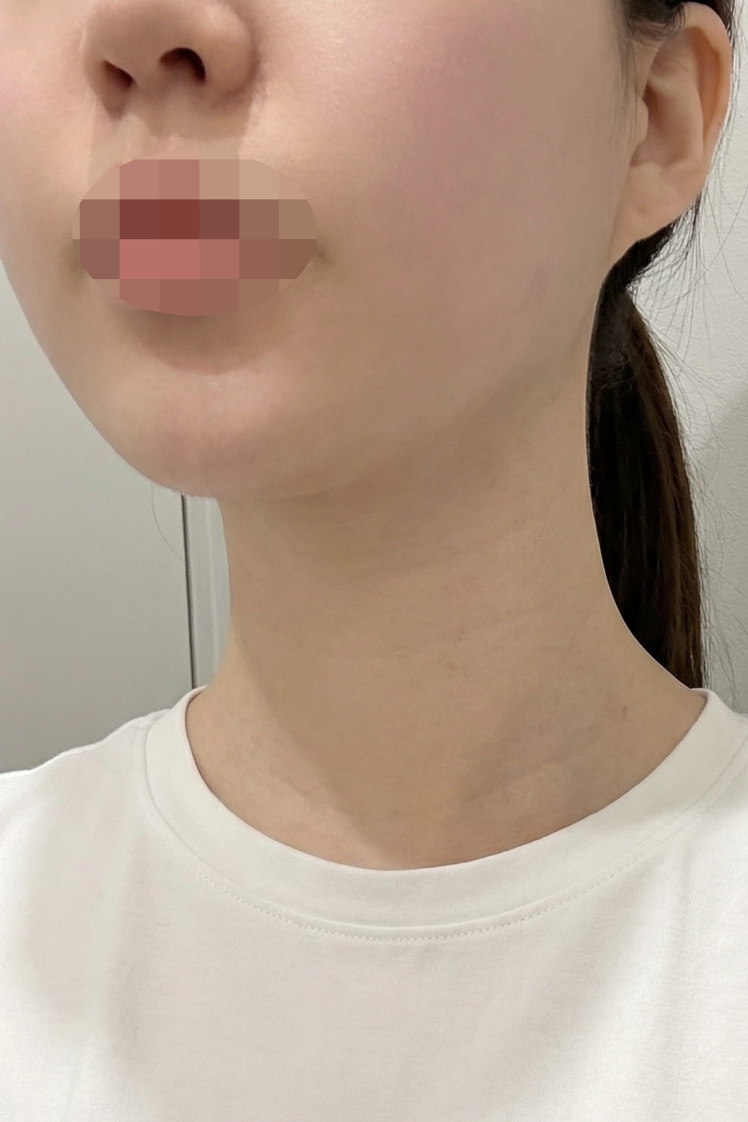 라인 정리 받았는데 얼굴 날렵해진 것 같아요!