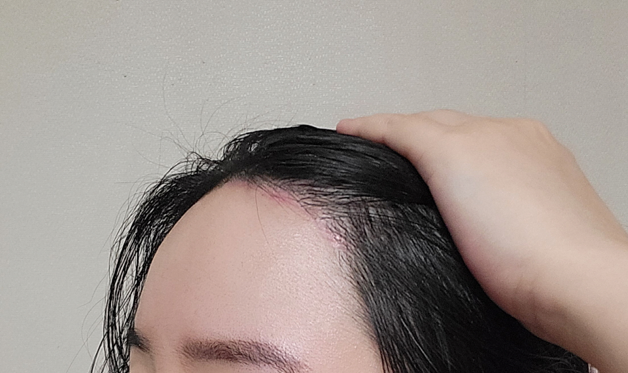 흉터도 많이 옅어지고 통증도 없습니다. 만족스러워요