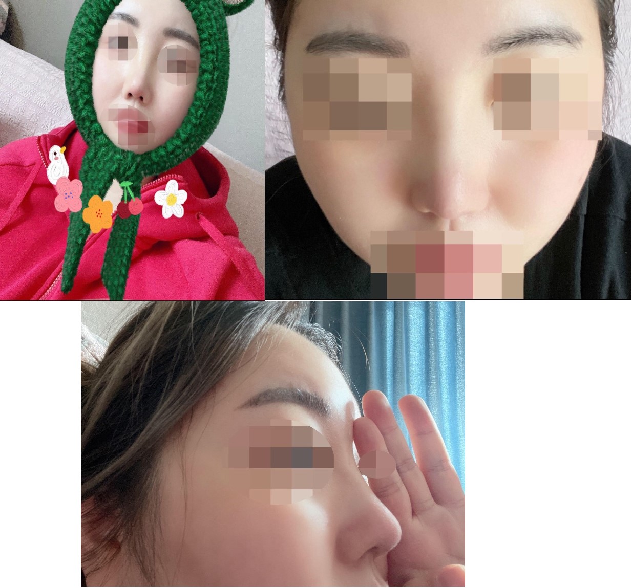 낮은코 수술 후기!