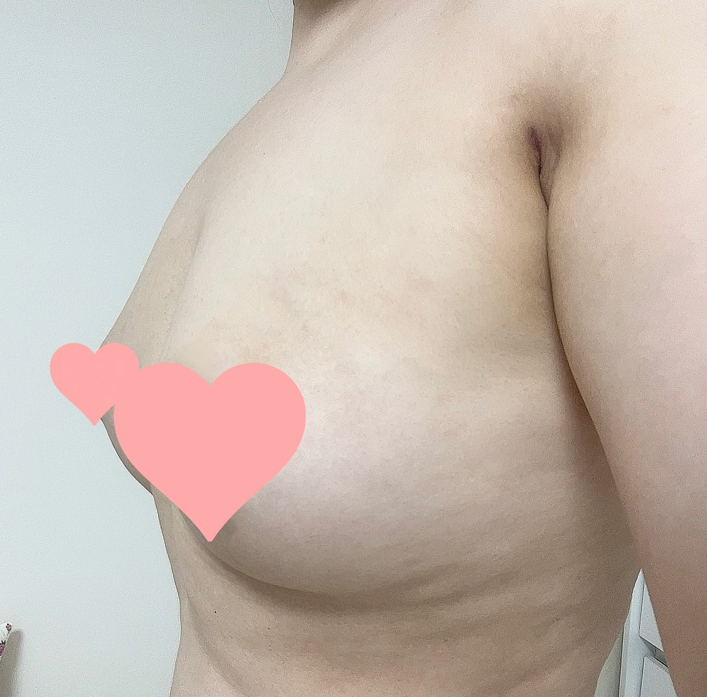자연스러운 볼륨감을 원하신다면 지방이식만한게 없는 것 같아요!