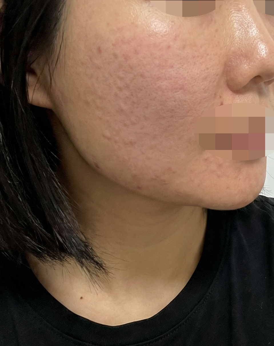 수면으로 받았는데 자고 일어나니 끝나 있어서 편하고 좋네요!ㅎㅎ