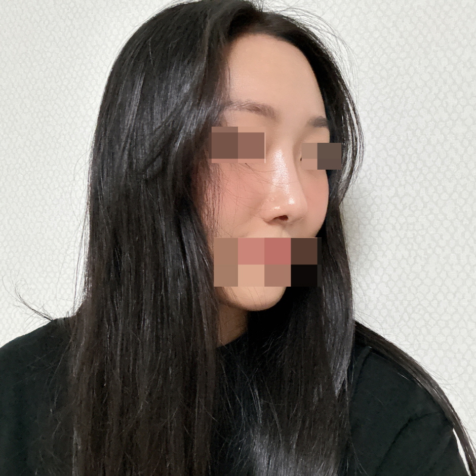 붓기 빨리 빠지고 흉터도 많이 옅어졌어요 만족 ^^
