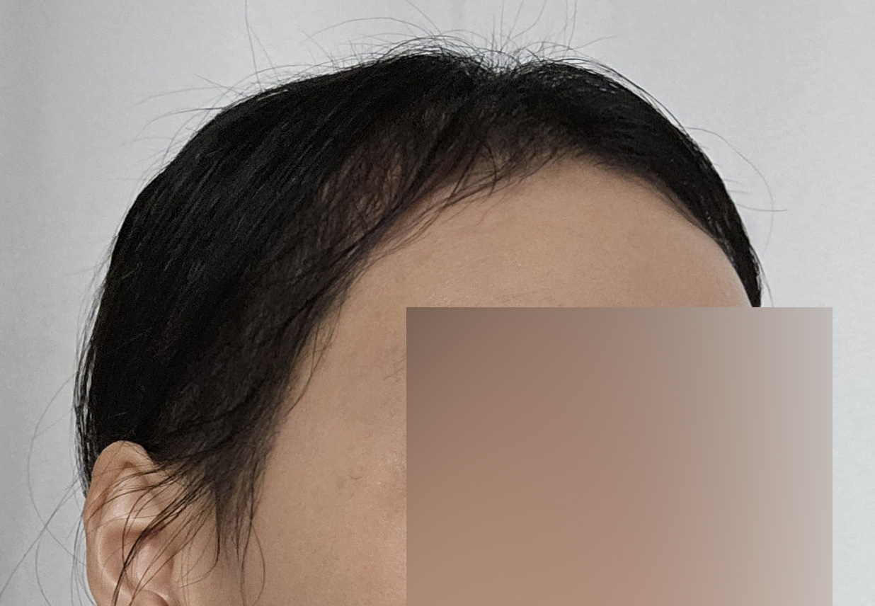 비절개 삭발 모발이식 4달차 후기, 얼굴이 작아 보인다는 말 많이 들어요
