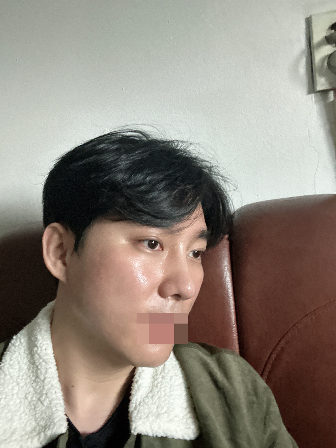 아직 붓기가 완벽하게 빠지진 않았지만 자연스럽게 자리 잡아가고 있어요