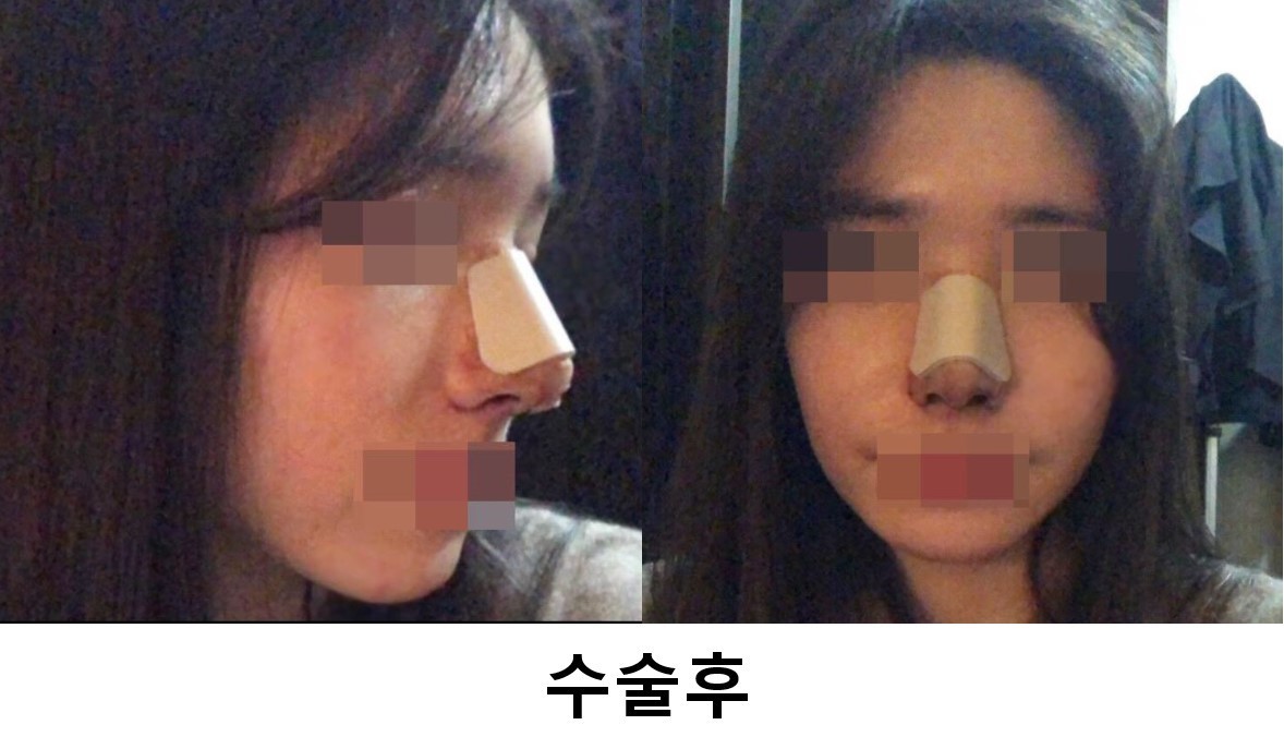 코수술 6일차