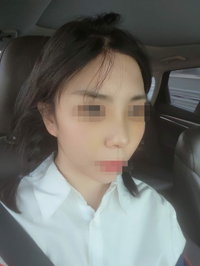 코수술 했어요!
