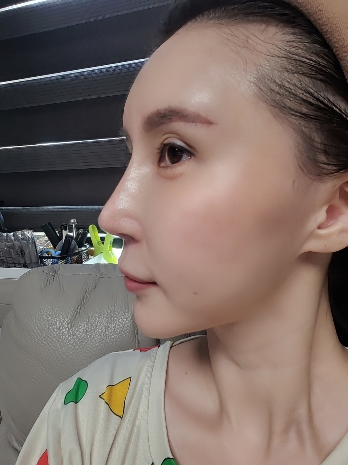코재수술 굉장히 만족하고있고 눈썹하안검으로 시야도 넓어졌어요 ㅎㅎ