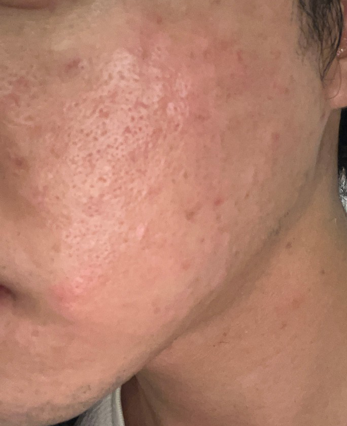 수면 리쥬란 엠보 하루 만에 가라앉고 너무 만족스러웠어요.
