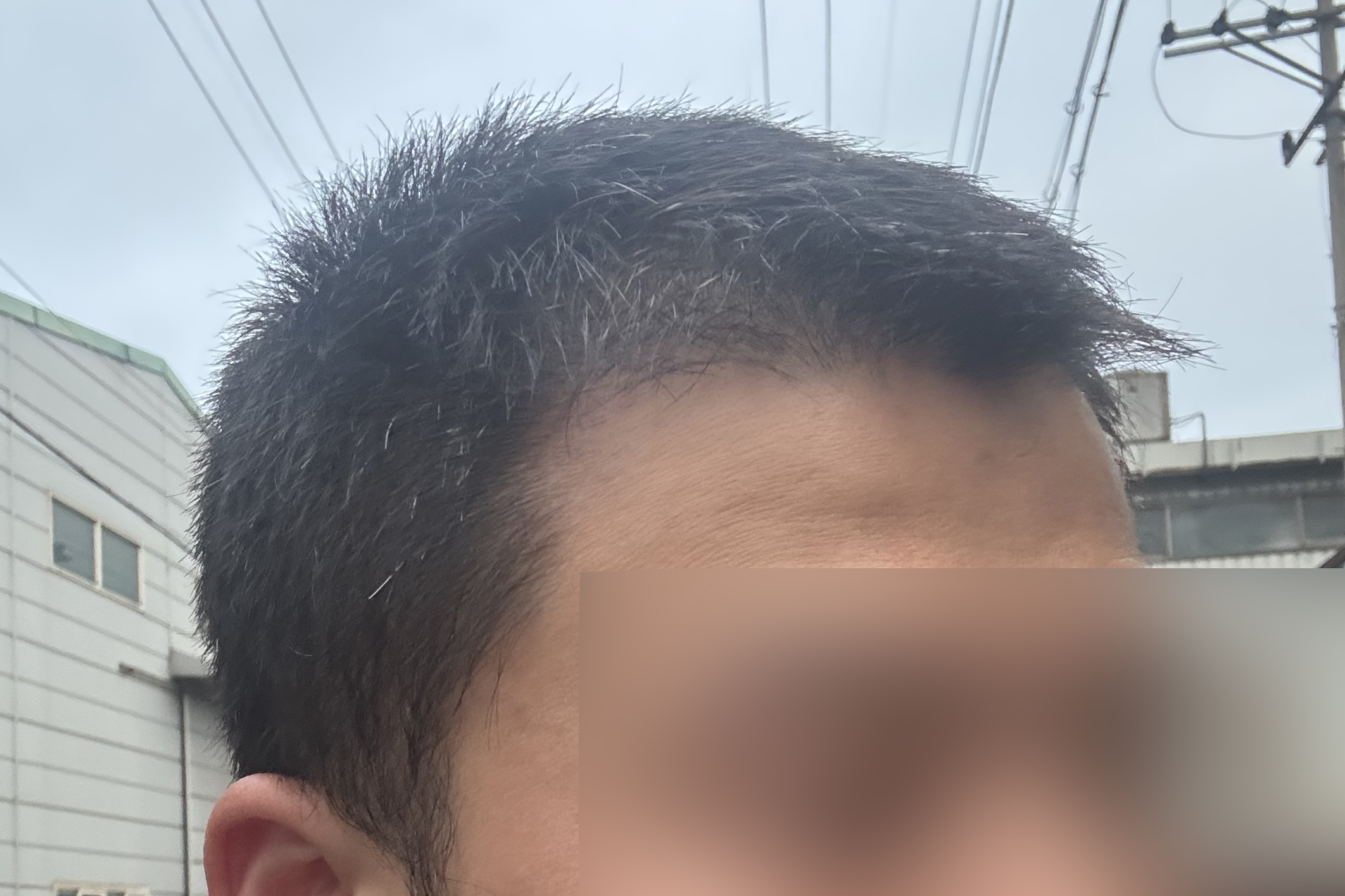 비절개 삭발 모발이식 2달차, 새머리를 기다리는 시간~!