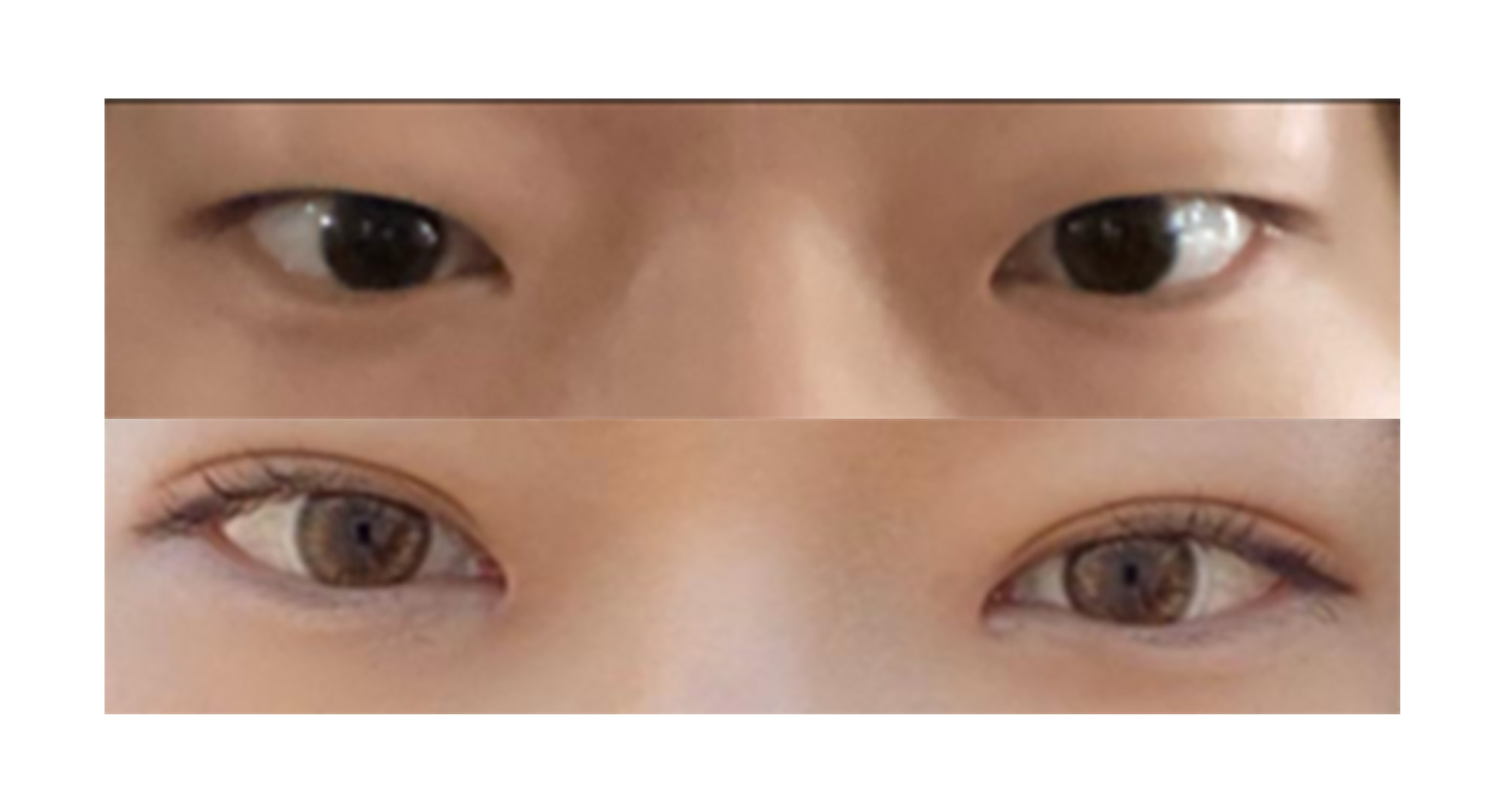 자연유착 쌍꺼풀 수술 추천!