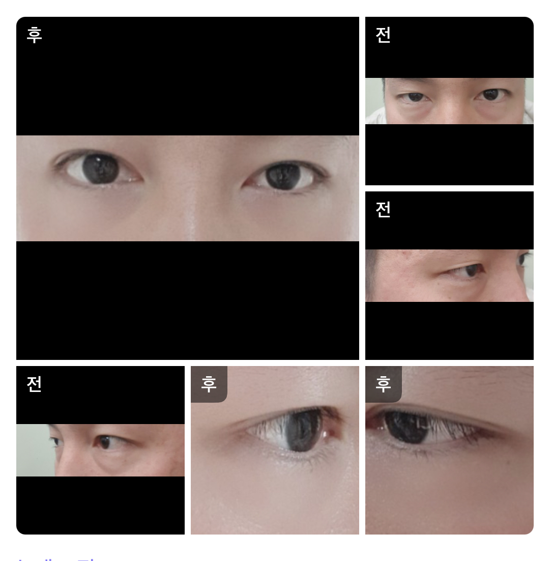 눈매교정,눈밑지방재배치,쌍꺼풀 받았습니당