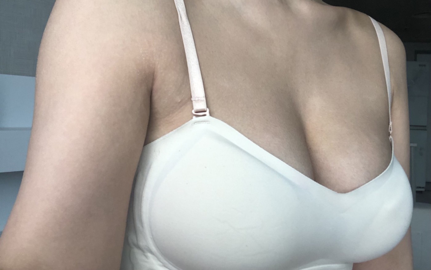 수술 너무 잘 됐고 만족스러워요~~