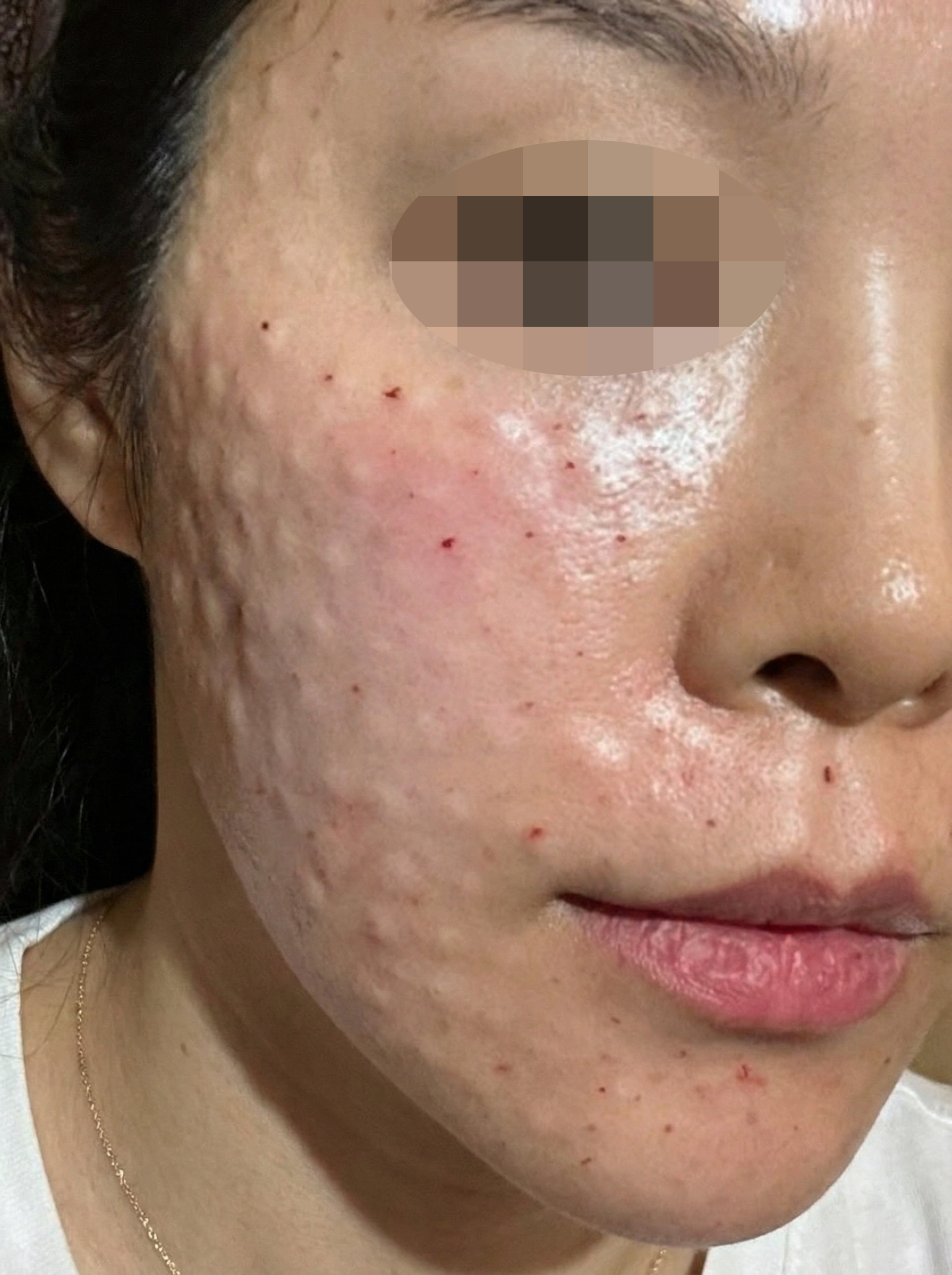 피부탄력 고민이라 리쥬베룩 받았는데 재방문 예정이에요!
