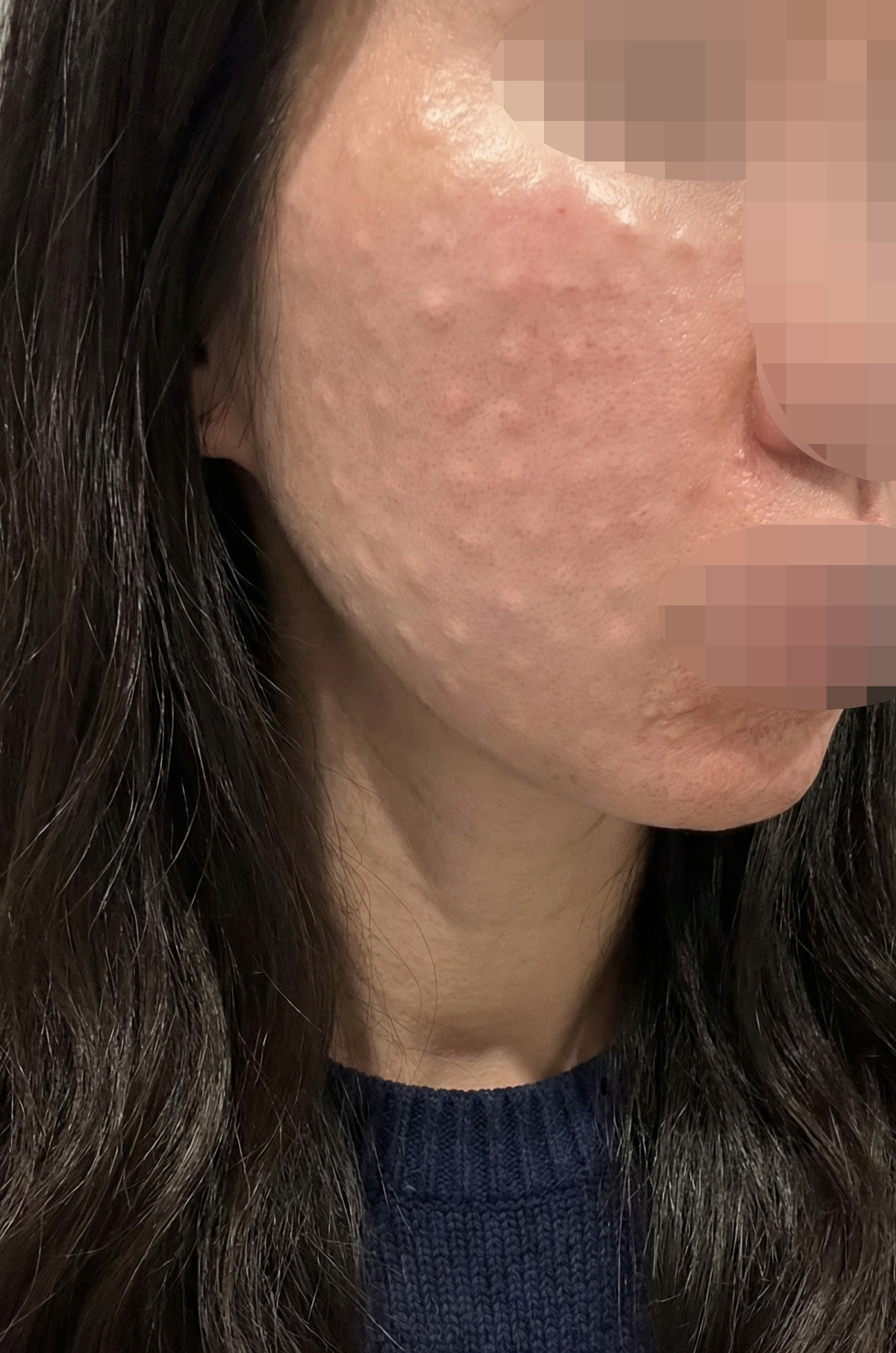 효과 좋아서 재방문했고 앞으로도 받을 예정입니다~