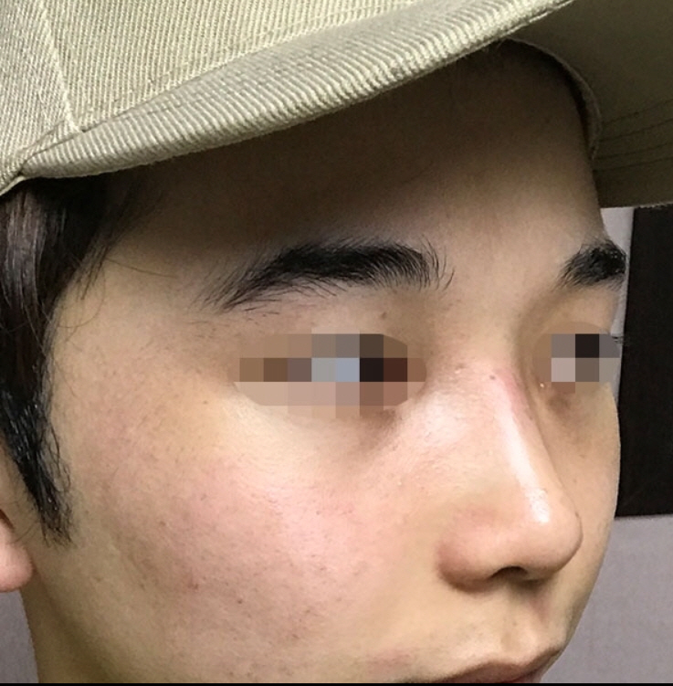 매부리코 성형후기입니다