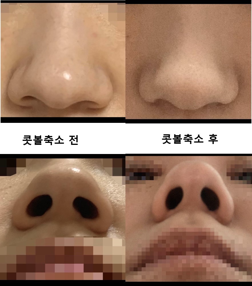 눈 + 콧볼축소 했습니당