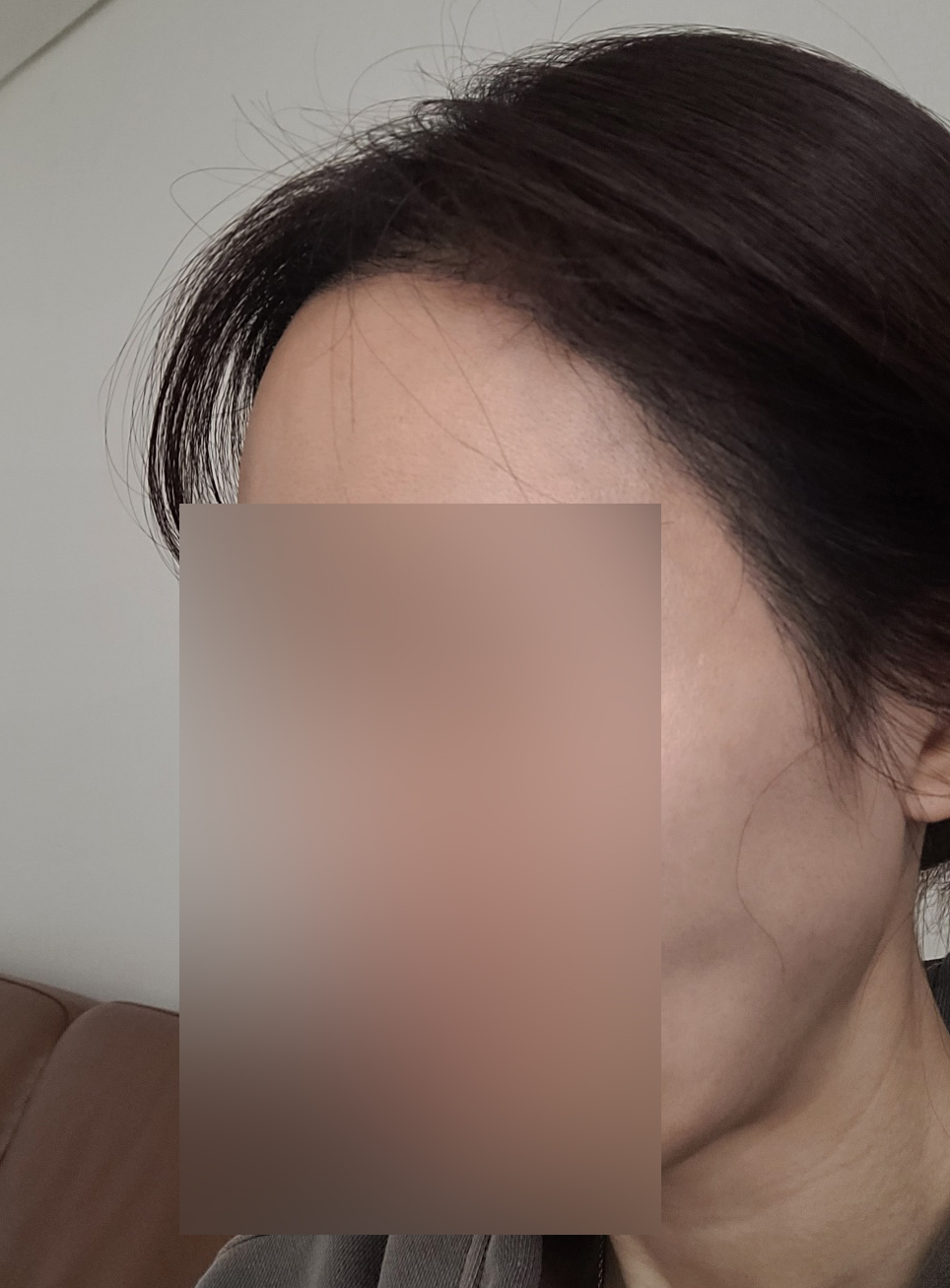 절개 모발이식 4달차, 머리카락이 잘 자라고 있어요