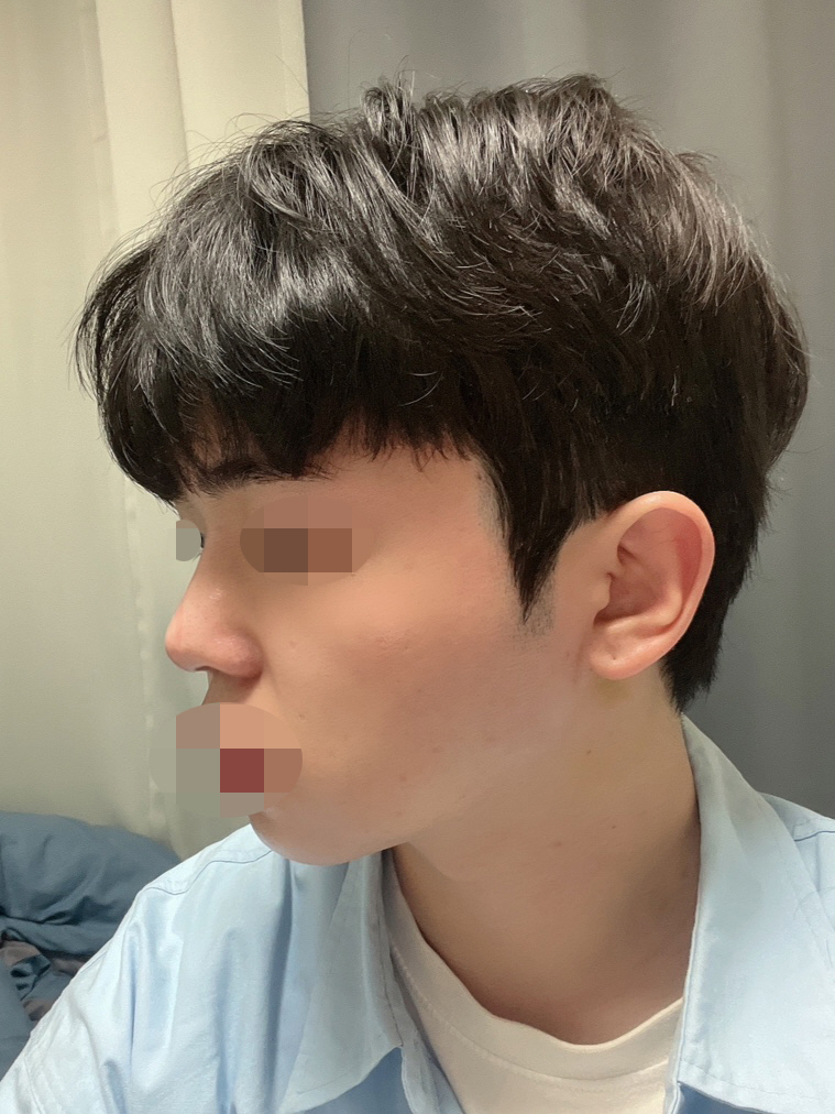 코 재수술 2주차입니다!