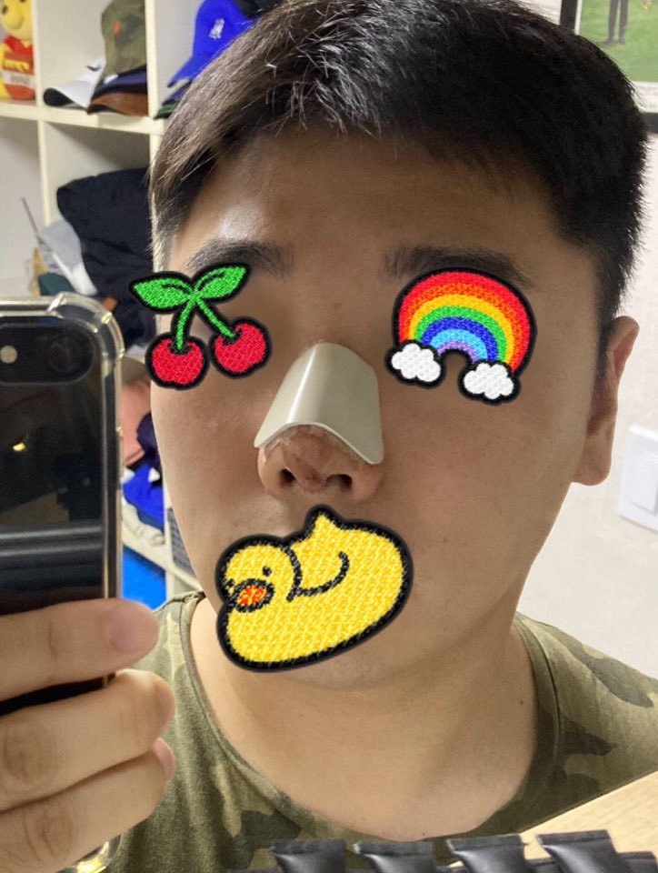 남자 복코 수술