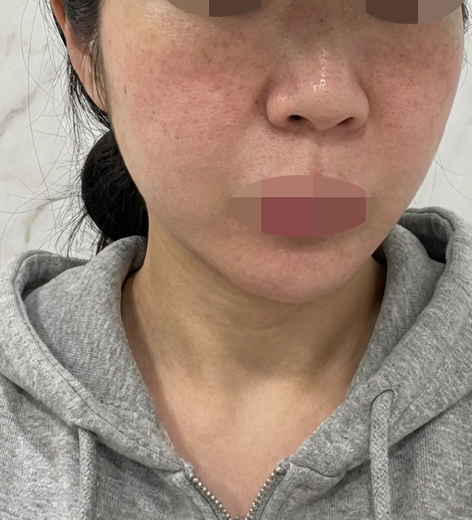 속건조 심해서 다들 추천해준 리쥬란 받았는데 엠보 촘촘해서 만족이에요 ㅎㅎ