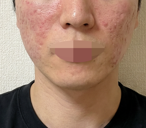 약속 많아지고, 피부 노화 체감에 리쥬란 받아봤습니다.