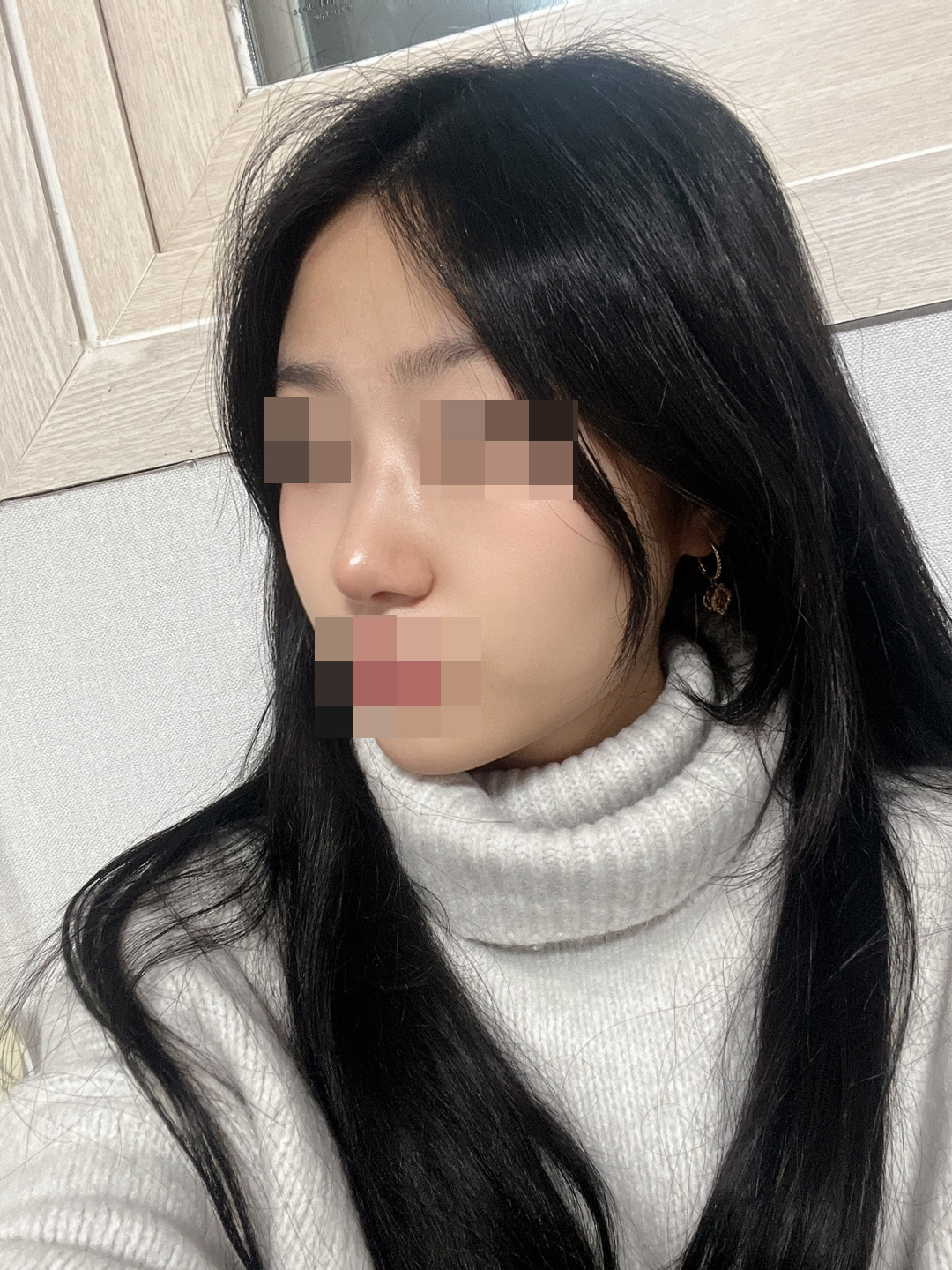 매부리도 깎고 코끝도 얄쌍 하게 올려서 이쁘게됐어요~