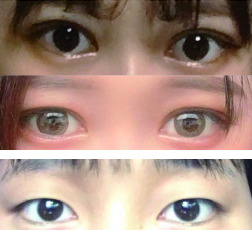 자연유착 수술후기
