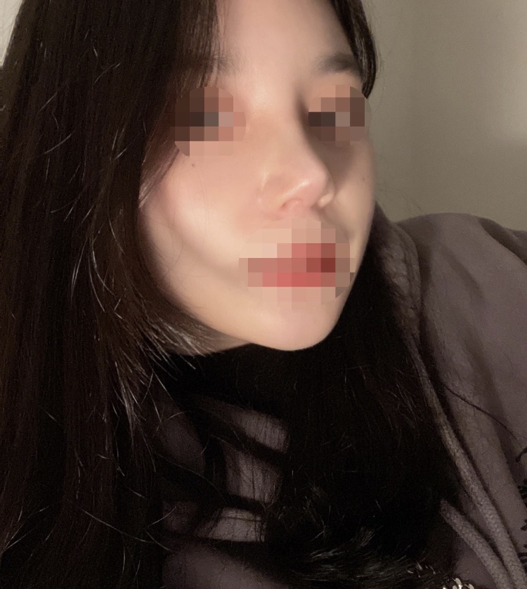 코 수술 2개월 차 후기 :)