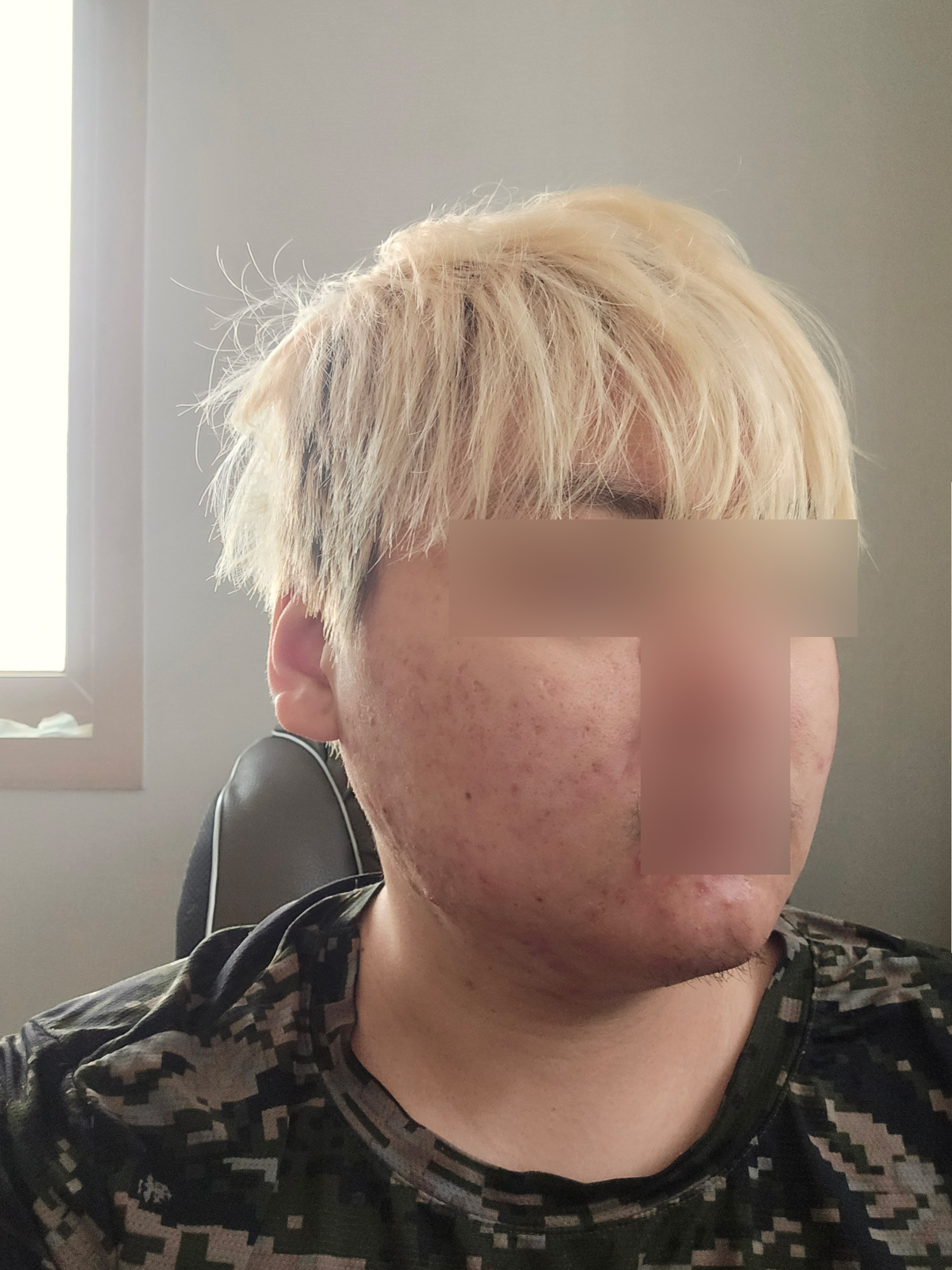 얼굴지방흡입 후 3개월, 전반적으로 만족합니다