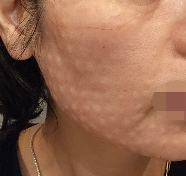 피부 늘어짐이랑 잔주름 고민으로 리쥬란 받아봤어요~