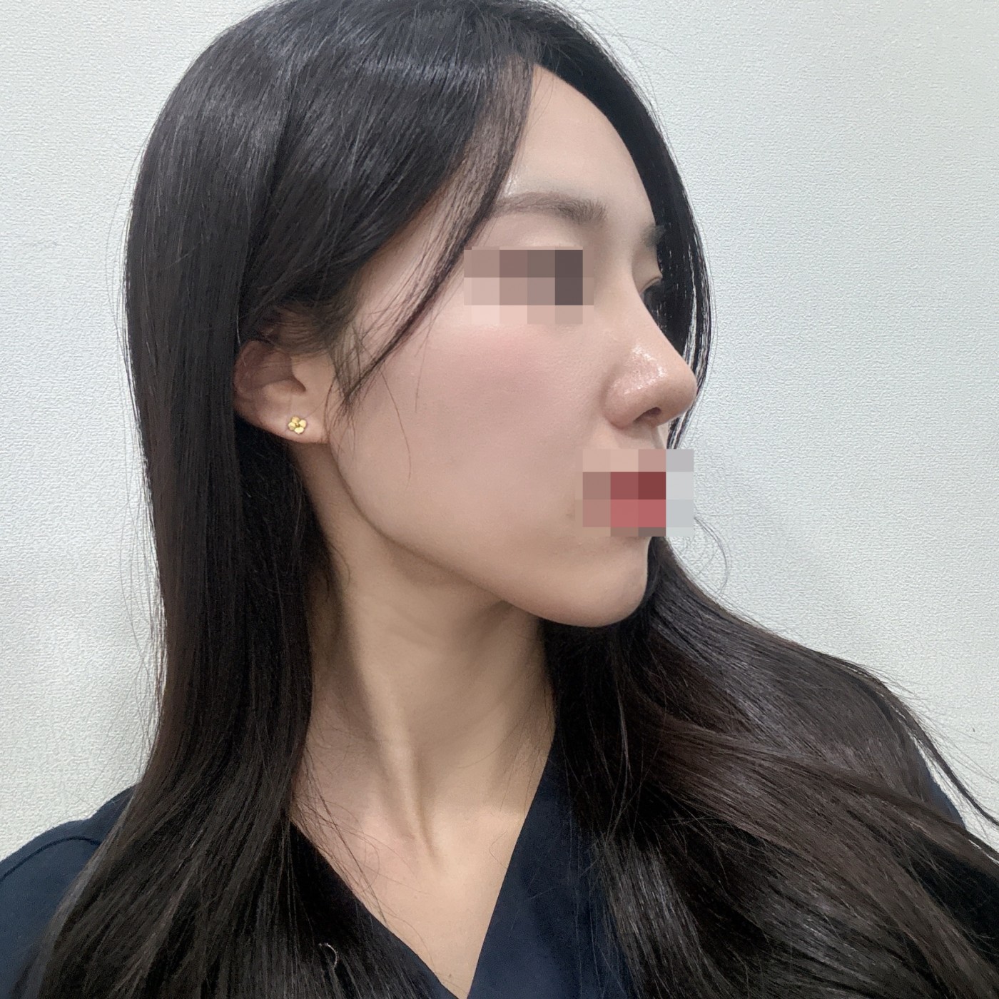원장님이 워낙 꼼꼼하시고 환자 니즈를 잘 파악해주셔요!!