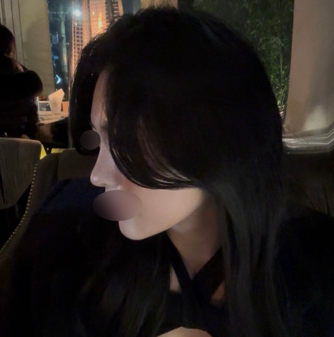코성형 변화! 3개월 지나니 진짜 예뻐졌어요