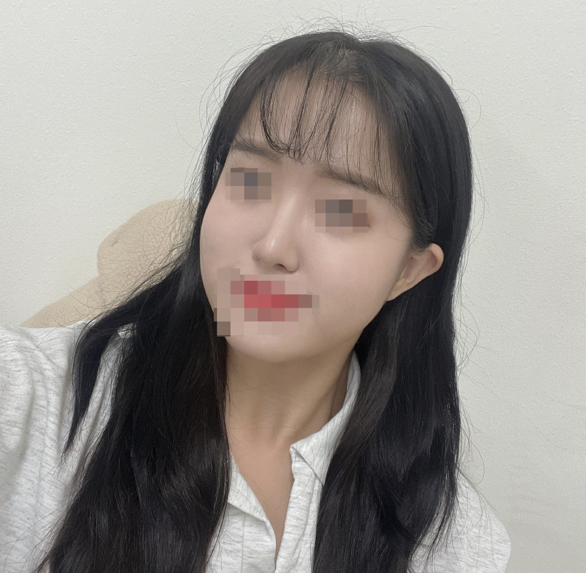 수술한지 두달이 지난 지금 너무 만족합니다~