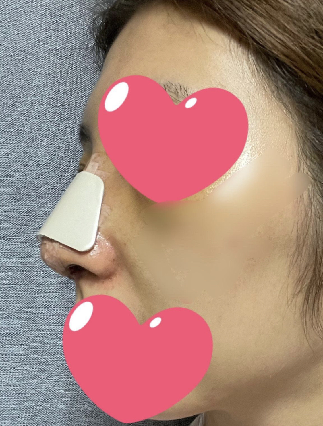 수술 후기 남겨요~