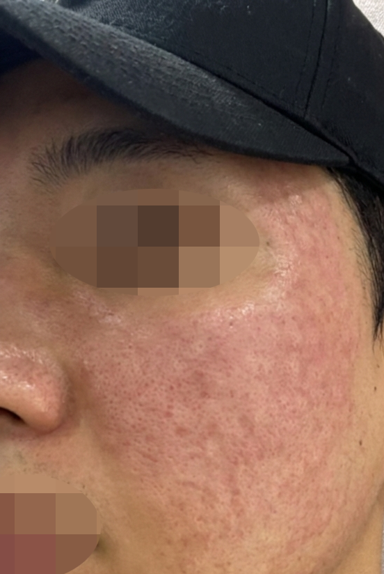 30대 되니 피부 탄력 떨어져서, 리쥬란으로 케어 시작했습니다.