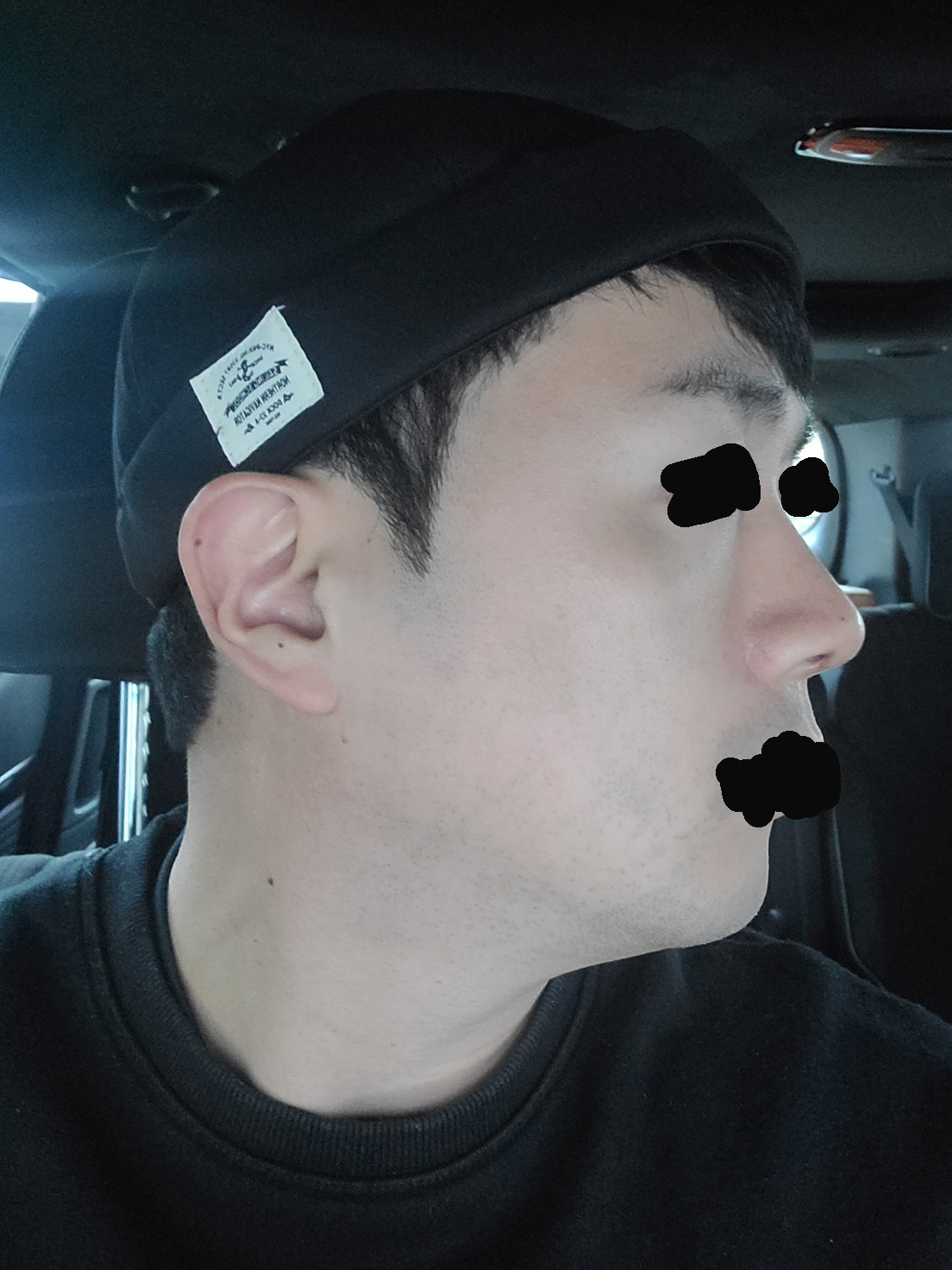확실히 정면에서 보는것 보다 측면에서 보았을때 확실히 달라졌습니다!... 잘 자리잡은거 같아 외모에 대한 만족도는 올랐어요
