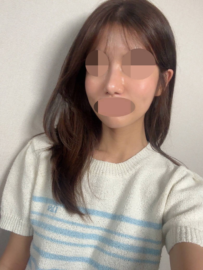매부리코 확실히 정리 잘 됐어요! 자연스러워서 좋아요~