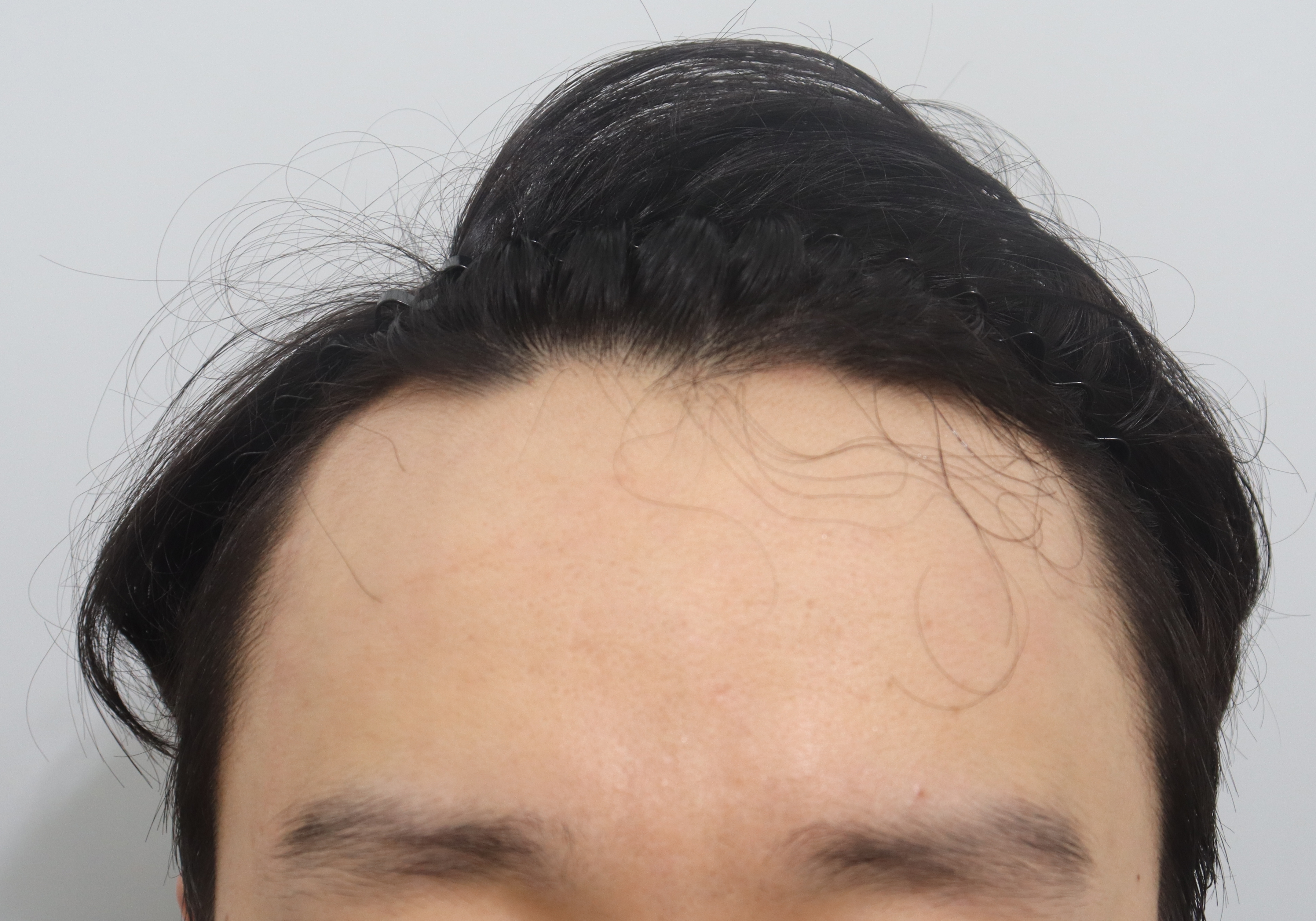 비절개 삭발 모발이식 2개월차, 암흑기 끝이 보이네요